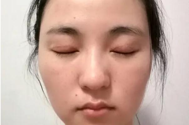 開眼角有必要嗎 開眼角會長回去嗎 開眼角有必要嗎 開眼角會長回去嗎