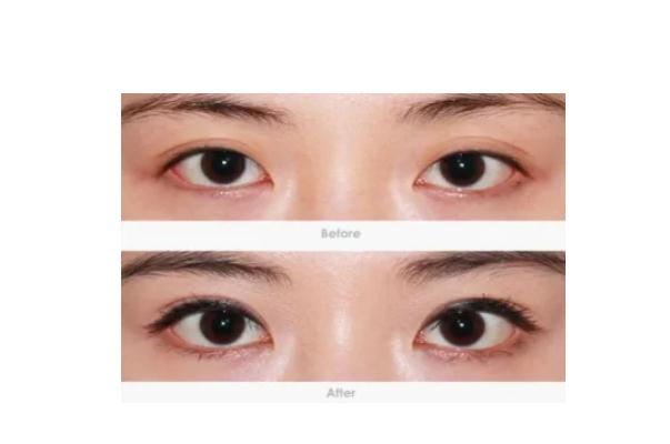 開眼角的副作用 開眼角的線沒拆干凈有影響嗎 開眼角的副作用 開眼角的線沒拆干凈有影響嗎