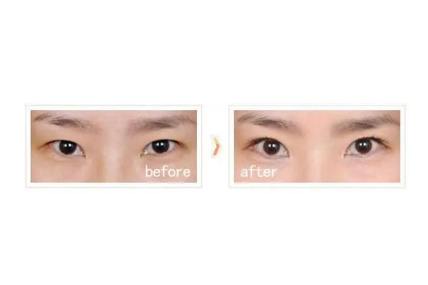 開眼角會顯老嗎 開眼角對眼睛有危害嗎 開眼角會顯老嗎 開眼角對眼睛有危害嗎