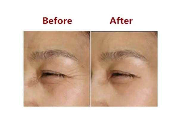 肉毒素除皺一針保持多長時間 肉毒素除皺的基本原理 肉毒素除皺一針保持多長時間 肉毒素除皺的基本原理