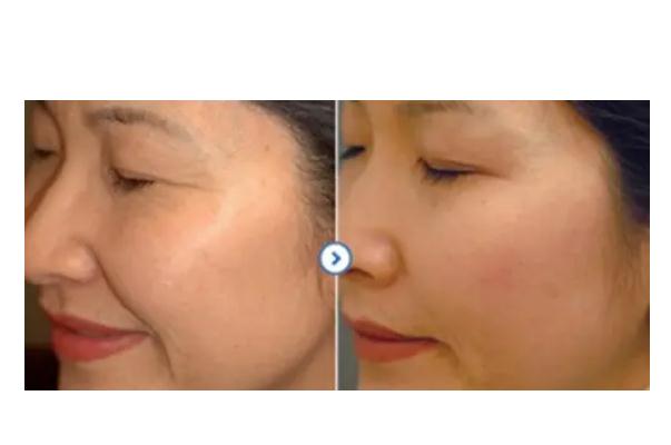 肉毒素除皺一針保持多長時間 肉毒素除皺的基本原理 肉毒素除皺一針保持多長時間 肉毒素除皺的基本原理