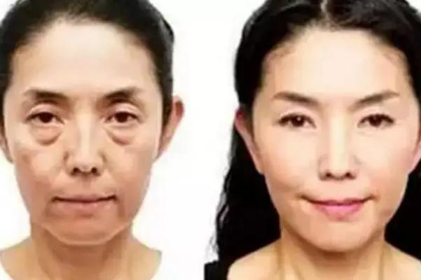 肉毒素除皺要一直打嗎 肉毒素除皺要打幾次定型 肉毒素除皺要一直打嗎 肉毒素除皺要打幾次定型