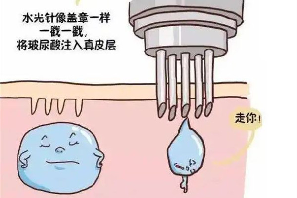 水光針打深好還是淺好 水光針去皺紋維持多久 水光針打深好還是淺好 水光針去皺紋維持多久