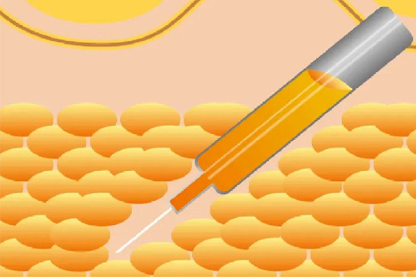 吸脂可以報(bào)醫(yī)保嗎 吸脂去三甲醫(yī)院還是美容醫(yī)院 吸脂可以報(bào)醫(yī)保嗎 吸脂去三甲醫(yī)院還是美容醫(yī)院