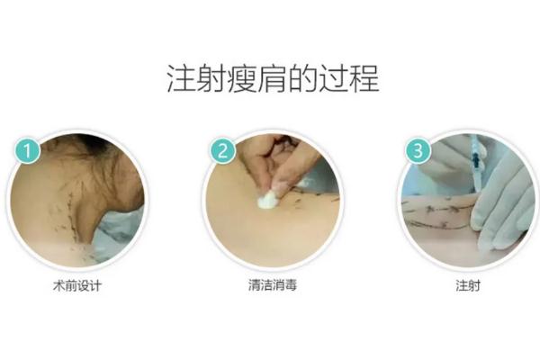 瘦肩針會不會手臂沒力氣 瘦肩針打完可以平躺嗎 瘦肩針會不會手臂沒力氣 瘦肩針打完可以平躺嗎