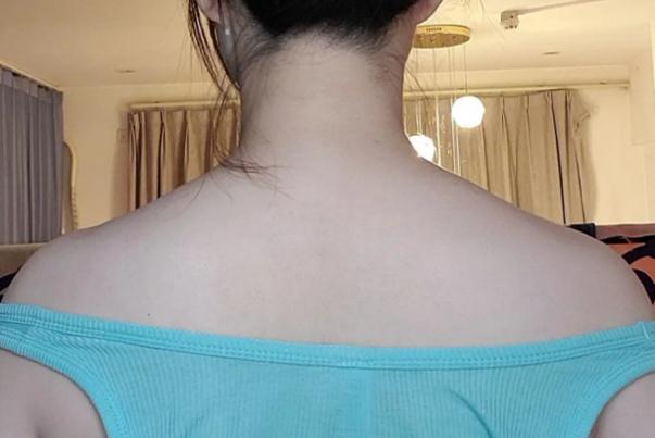 瘦肩針可以消除富貴包嗎 瘦肩針對(duì)頸椎有好處嗎 瘦肩針可以消除富貴包嗎 瘦肩針對(duì)頸椎有好處嗎