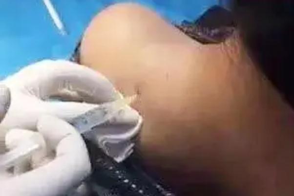 瘦肩針的原理是怎么瘦的 瘦肩針的副作用有哪些 瘦肩針的原理是怎么瘦的 瘦肩針的副作用有哪些