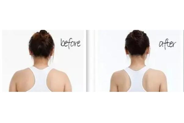 瘦肩針可以維持多久 瘦肩針可以瘦手臂嗎 瘦肩針可以維持多久 瘦肩針可以瘦手臂嗎