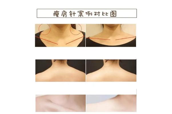 瘦肩針有什么危害和副作用 瘦肩針一針大概多少錢(qián) 瘦肩針有什么危害和副作用 瘦肩針一針大概多少錢(qián)