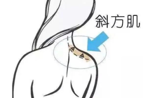 瘦肩針是打在哪塊肌肉上的 瘦肩針是打肉毒素還是溶脂針 瘦肩針是打在哪塊肌肉上的 瘦肩針是打肉毒素還是溶脂針