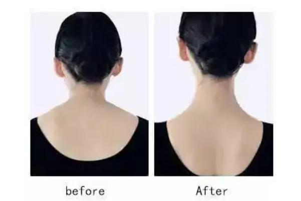 瘦肩針的原理是怎么瘦的 瘦肩針的副作用有哪些 瘦肩針的原理是怎么瘦的 瘦肩針的副作用有哪些