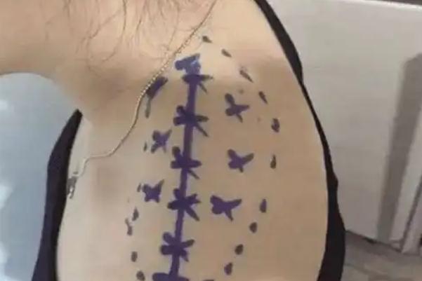 瘦肩針有什么危害和副作用 瘦肩針一針大概多少錢(qián) 瘦肩針有什么危害和副作用 瘦肩針一針大概多少錢(qián)