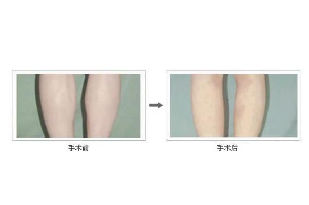 瘦腿針會(huì)導(dǎo)致靜脈曲張嗎 瘦腿針能維持多長(zhǎng)時(shí)間 瘦腿針會(huì)導(dǎo)致靜脈曲張嗎 瘦腿針能維持多長(zhǎng)時(shí)間