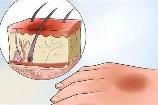 祛疤手術(shù)后要戒辛辣多長(zhǎng)時(shí)間 祛疤手術(shù)后不能吃什么 祛疤手術(shù)后要戒辛辣多長(zhǎng)時(shí)間 祛疤手術(shù)后不能吃什么