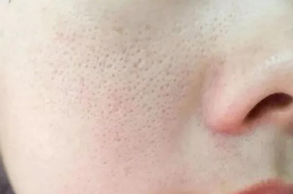 毛孔粗大怎么辦怎么收縮毛孔 毛孔粗大用什么護膚品可以改善 毛孔粗大怎么辦怎么收縮毛孔 毛孔粗大用什么護膚品可以改善