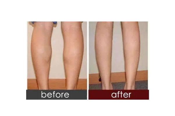 瘦腿針會(huì)導(dǎo)致靜脈曲張嗎 瘦腿針能維持多長(zhǎng)時(shí)間 瘦腿針會(huì)導(dǎo)致靜脈曲張嗎 瘦腿針能維持多長(zhǎng)時(shí)間