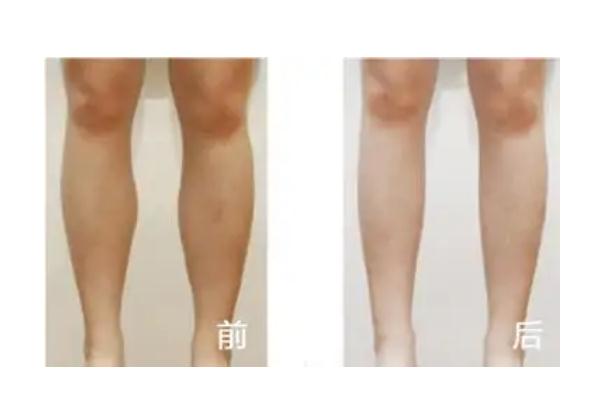 瘦腿針可以瘦幾厘米 瘦腿針可以自己打嗎 瘦腿針可以瘦幾厘米 瘦腿針可以自己打嗎