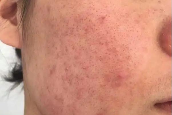 毛孔粗大有痘坑怎么修復 毛孔粗大有幾種類型 毛孔粗大有痘坑怎么修復 毛孔粗大有幾種類型