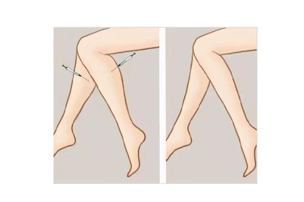 瘦腿針真的能瘦腿嗎 瘦腿針有沒(méi)有副作用