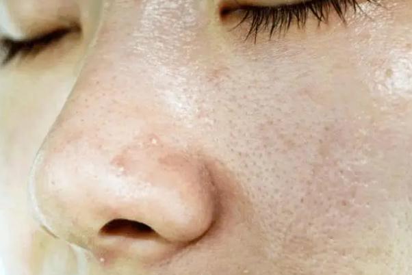 毛孔粗大有痘坑怎么修復 毛孔粗大有幾種類型 毛孔粗大有痘坑怎么修復 毛孔粗大有幾種類型