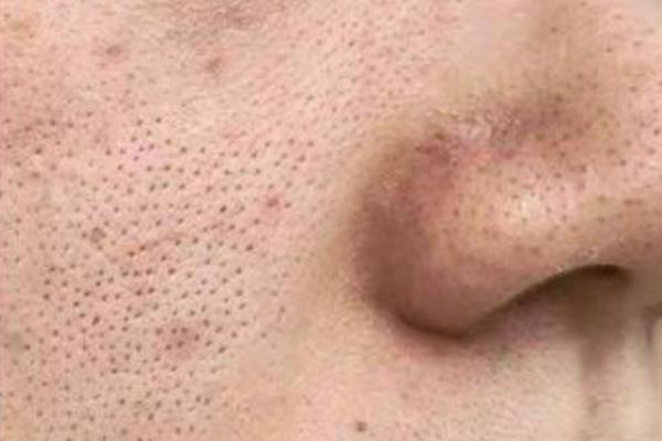 毛孔粗大怎么辦怎么收縮毛孔 毛孔粗大用什么護膚品可以改善 毛孔粗大怎么辦怎么收縮毛孔 毛孔粗大用什么護膚品可以改善