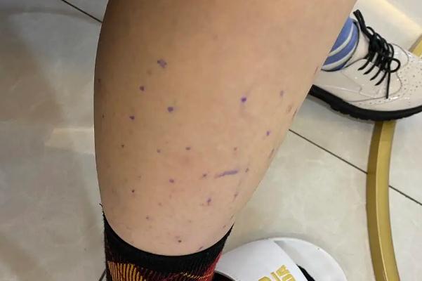 瘦腿針對(duì)脂肪腿有效果嗎 瘦腿針對(duì)身體有傷害嗎 瘦腿針對(duì)脂肪腿有效果嗎 瘦腿針對(duì)身體有傷害嗎