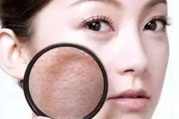 毛孔粗大有痘坑怎么修復 毛孔粗大有幾種類型 毛孔粗大有痘坑怎么修復 毛孔粗大有幾種類型