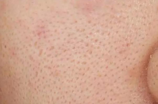 毛孔粗大有黑頭怎么辦 毛孔粗大能修復(fù)嗎 毛孔粗大有黑頭怎么辦 毛孔粗大能修復(fù)嗎