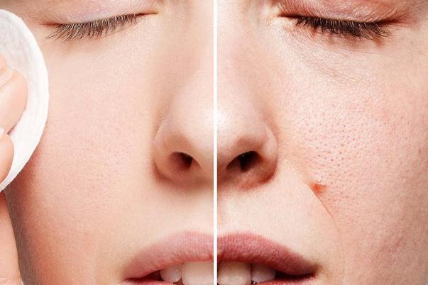 毛孔粗大會自己好嗎 毛孔粗大會導(dǎo)致什么后果 毛孔粗大會自己好嗎 毛孔粗大會導(dǎo)致什么后果