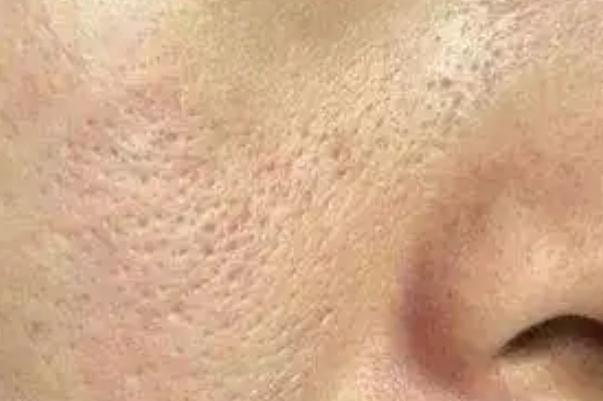 毛孔粗大有黑頭怎么辦 毛孔粗大能修復(fù)嗎 毛孔粗大有黑頭怎么辦 毛孔粗大能修復(fù)嗎