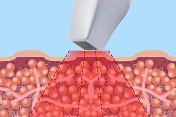 熱瑪吉要避開月經(jīng)期的原因 熱瑪吉要恢復多久 熱瑪吉要避開月經(jīng)期的原因 熱瑪吉要恢復多久