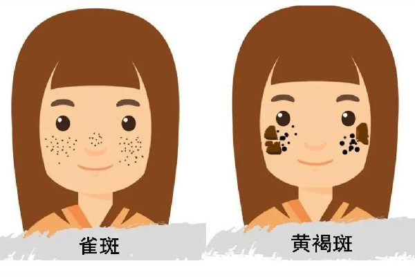 皮秒祛斑會反彈嗎 皮秒祛斑后要注意什么事項(xiàng) 皮秒祛斑會反彈嗎 皮秒祛斑后要注意什么事項(xiàng)