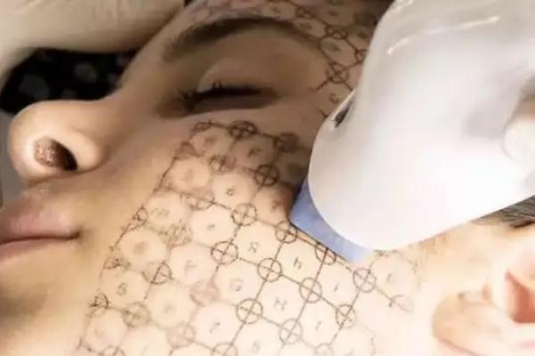 熱瑪吉是什么原理 熱瑪吉是什么美容項(xiàng)目 熱瑪吉是什么原理 熱瑪吉是什么美容項(xiàng)目