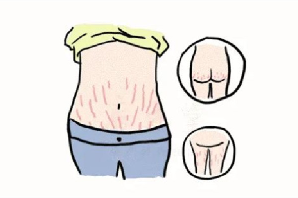 肥胖紋有時候明顯有時候不明顯 肥胖紋會一直擴散嗎 肥胖紋有時候明顯有時候不明顯 肥胖紋會一直擴散嗎