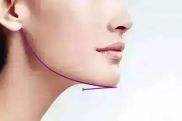玻尿酸填充下巴是不是越尖越好 玻尿酸填充下巴是怎么形成的 玻尿酸填充下巴是不是越尖越好 玻尿酸填充下巴是怎么形成的