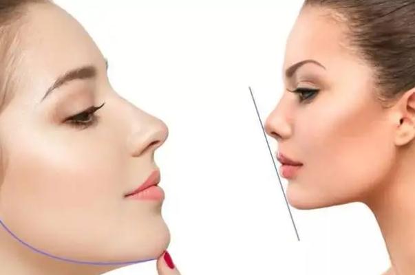 玻尿酸填充下巴的副作用 玻尿酸填充下巴的注意事項(xiàng) 玻尿酸填充下巴的副作用 玻尿酸填充下巴的注意事項(xiàng)