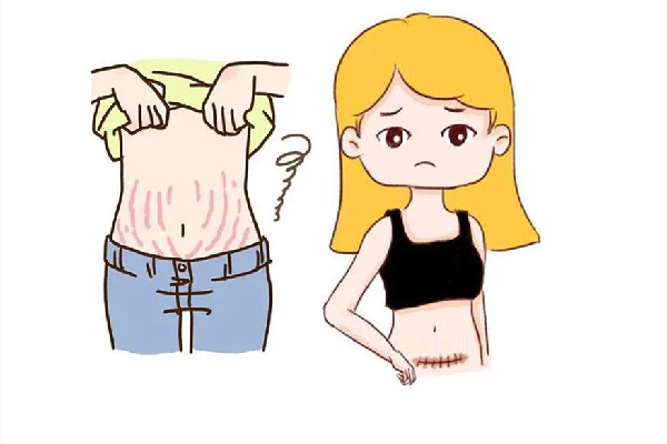 妊娠紋用激光可以去除掉嗎 妊娠紋激光手術(shù)多少錢 妊娠紋用激光可以去除掉嗎 妊娠紋激光手術(shù)多少錢