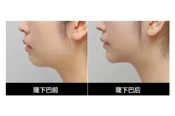 玻尿酸填充下巴的副作用 玻尿酸填充下巴的注意事項(xiàng) 玻尿酸填充下巴的副作用 玻尿酸填充下巴的注意事項(xiàng)