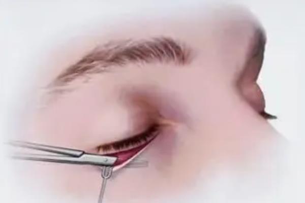 去眼袋手術(shù)后注意事項 去眼袋手術(shù)要多久恢復(fù)正常 去眼袋手術(shù)后注意事項 去眼袋手術(shù)要多久恢復(fù)正常