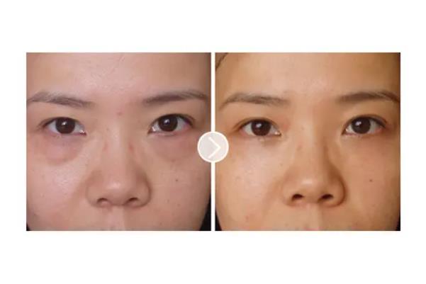 去眼袋手術(shù)會(huì)失敗嗎 去眼袋手術(shù)會(huì)導(dǎo)致眼失明嗎 去眼袋手術(shù)會(huì)失敗嗎 去眼袋手術(shù)會(huì)導(dǎo)致眼失明嗎