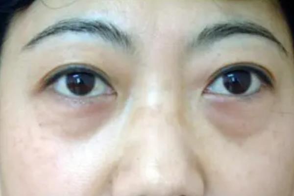 去眼袋手術(shù)會反彈嗎 去眼袋手術(shù)會不會把臥蠶做沒了 去眼袋手術(shù)會反彈嗎 去眼袋手術(shù)會不會把臥蠶做沒了