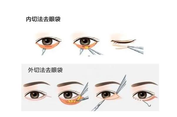 去眼袋手術費用大概多少錢 去眼袋手術有危害嗎 去眼袋手術費用大概多少錢 去眼袋手術有危害嗎