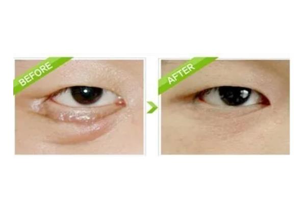 去眼袋手術(shù)會反彈嗎 去眼袋手術(shù)會不會把臥蠶做沒了 去眼袋手術(shù)會反彈嗎 去眼袋手術(shù)會不會把臥蠶做沒了