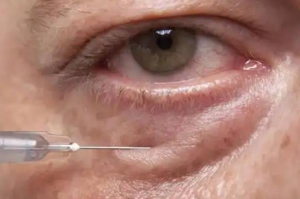 去眼袋手術(shù)有幾種 去眼袋手術(shù)有效果嗎 去眼袋手術(shù)有幾種 去眼袋手術(shù)有效果嗎