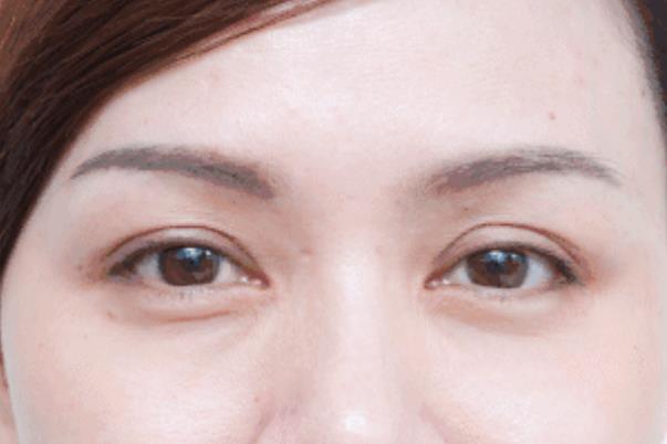 去眼袋手術(shù)會(huì)失敗嗎 去眼袋手術(shù)會(huì)導(dǎo)致眼失明嗎 去眼袋手術(shù)會(huì)失敗嗎 去眼袋手術(shù)會(huì)導(dǎo)致眼失明嗎