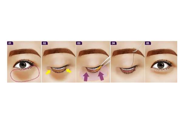 去眼袋手術(shù)的風(fēng)險(xiǎn) 去眼袋手術(shù)是睜眼做嗎 去眼袋手術(shù)的風(fēng)險(xiǎn) 去眼袋手術(shù)是睜眼做嗎