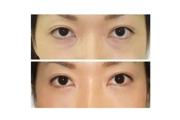 去眼袋手術(shù)的風(fēng)險(xiǎn) 去眼袋手術(shù)是睜眼做嗎 去眼袋手術(shù)的風(fēng)險(xiǎn) 去眼袋手術(shù)是睜眼做嗎