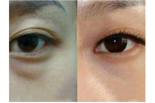 去眼袋手術費用大概多少錢 去眼袋手術有危害嗎 去眼袋手術費用大概多少錢 去眼袋手術有危害嗎