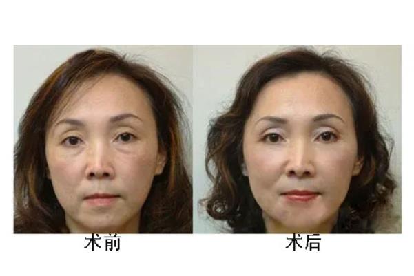 去眼袋手術(shù)后注意事項 去眼袋手術(shù)要多久恢復(fù)正常 去眼袋手術(shù)后注意事項 去眼袋手術(shù)要多久恢復(fù)正常