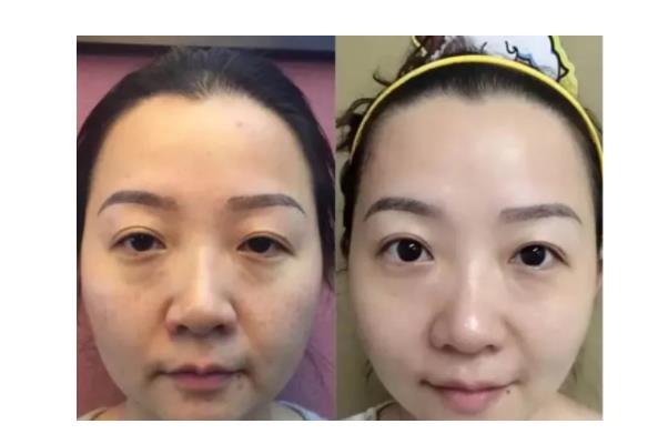 去眼袋手術(shù)后注意事項 去眼袋手術(shù)要多久恢復(fù)正常 去眼袋手術(shù)后注意事項 去眼袋手術(shù)要多久恢復(fù)正常